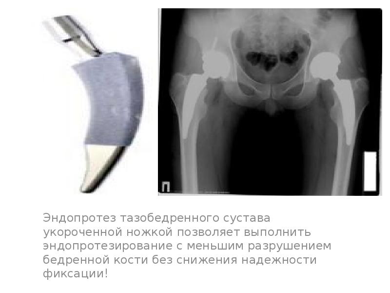 Эндопротезирование коленного сустава презентация