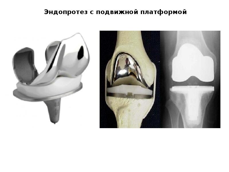 Эндопротезирование коленного сустава презентация