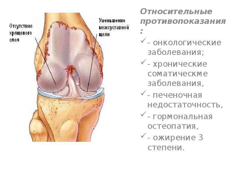 Эндопротезирование коленного сустава презентация