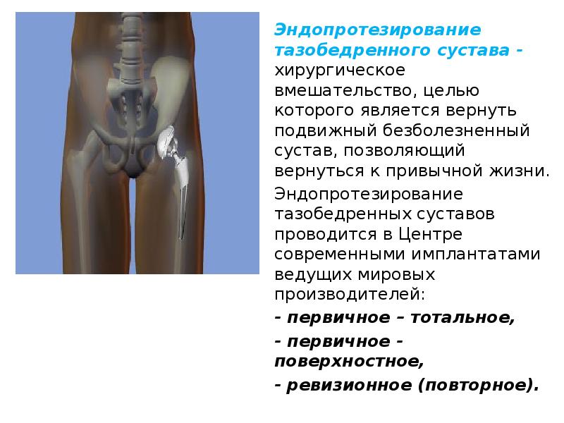 Протезирование коленного сустава презентация