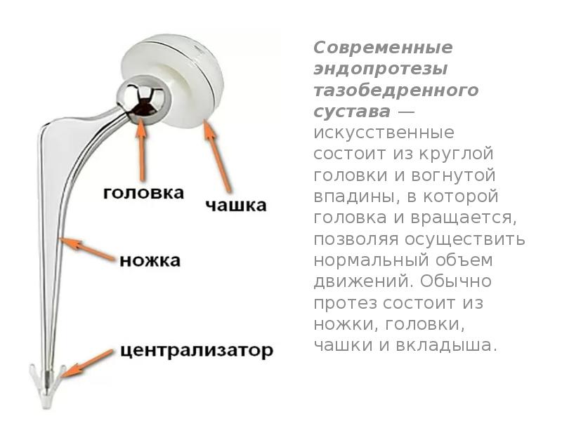 Эндопротезирование коленного сустава презентация