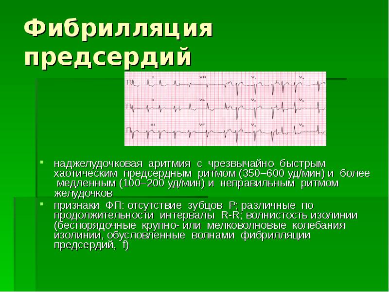 Фибриляция предсердий