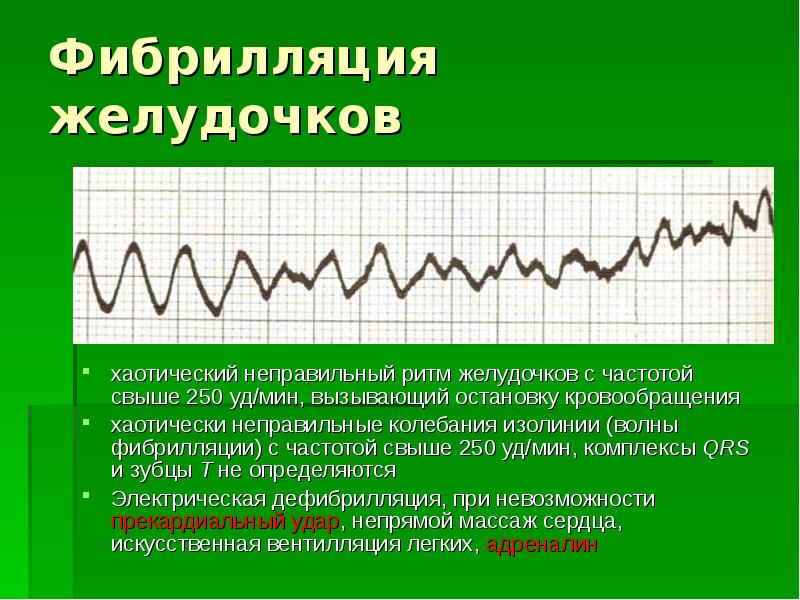 Нарушение ритма презентация