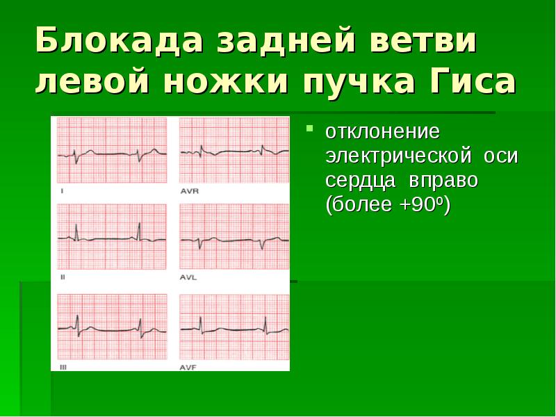 Блокада передней левой ножки гиса. Блокада передней ветви пучка Гиса на ЭКГ. Неполная блокада задней ветви ЛНПГ ЭКГ. Блокада передней ветви левой ножки пучка Гиса на ЭКГ. Блокада задней ветви ЛНПГ на ЭКГ.