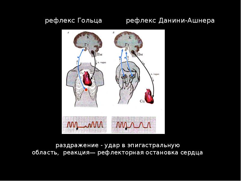 Схема рефлекторной дуги глазосердечного рефлекса