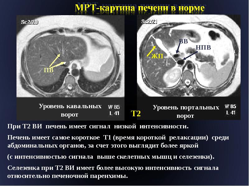 Т2 взвешенное изображение