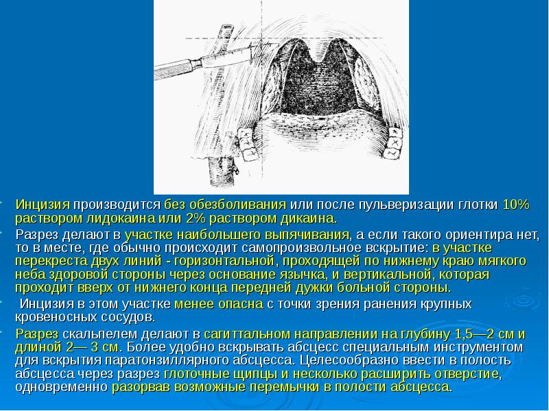 Парафарингеальный абсцесс презентация