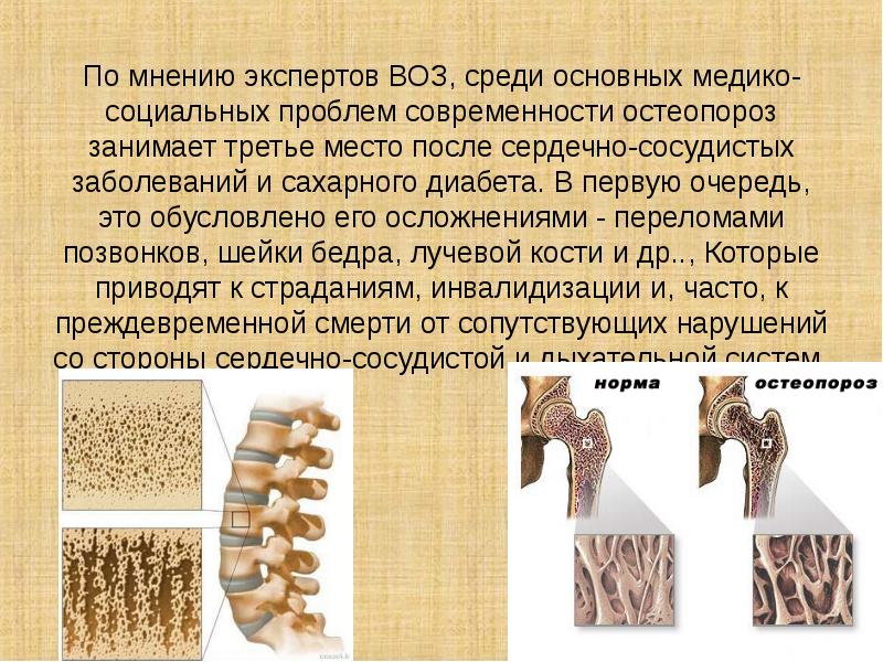 Остеопороз картинки для презентации