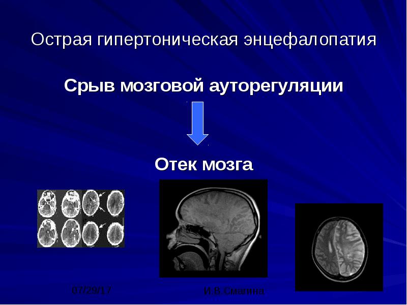мозговая гипертония
