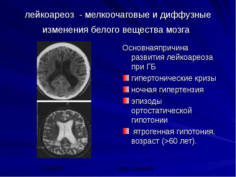 мозговая гипертония