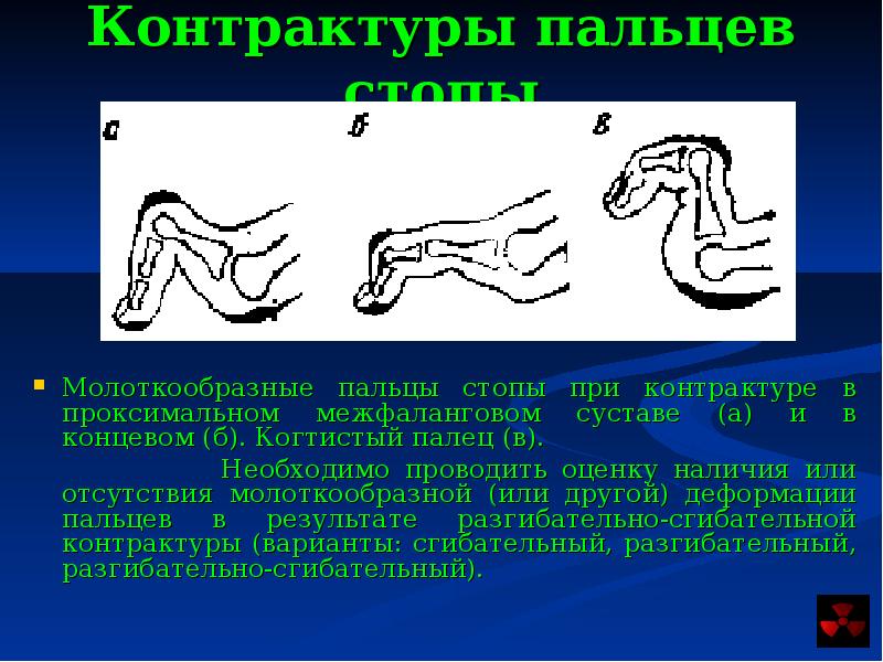 Контрактуры суставов код. Молоткообразная деформация пальцев рентген. Молоткообразная деформация пальцев стопы рентген. Контрактура межфалангового сустава на рентгене. Контрактура сустава пальца.