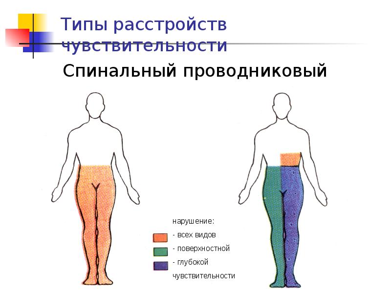 Схема нарушения чувствительности