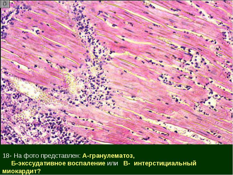 Виды пролиферативного воспаления