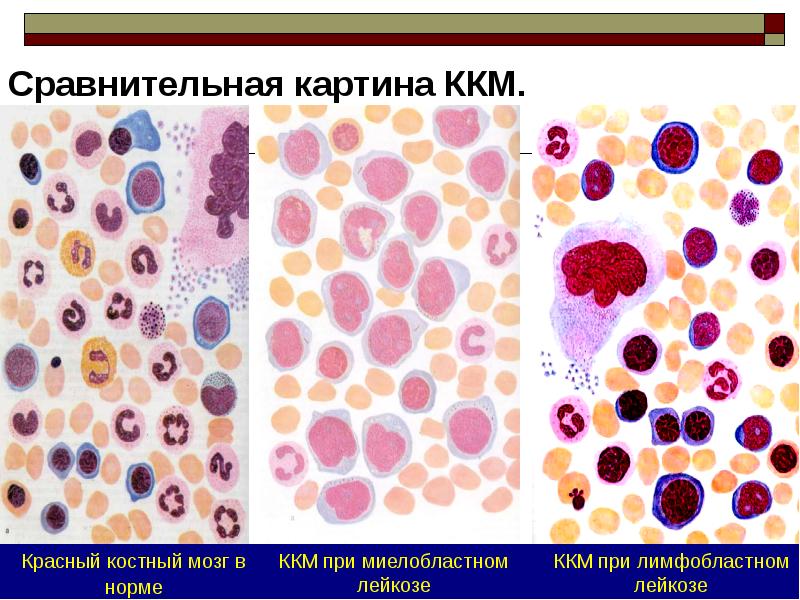 Картина крови при лейкозе