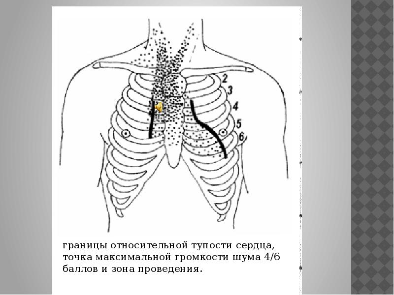 Абсолютная тупость. Границы тупости сердца. Относительная тупость сердца. Границы относительной сердечной тупости в норме. Относительная сердечная тупость границы.