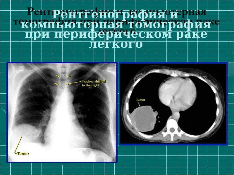 Рак легкого презентация онкология