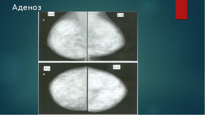 Аденоз на маммографии. Аденоз молочной железы рентген. Аденоз молочных желез на УЗИ. Аденоз молочных желез на маммографии.