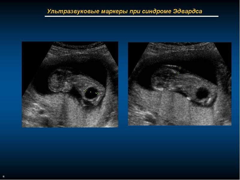Синдром эдвардса фото узи