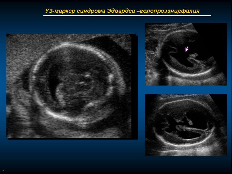 Синдром эдвардса фото узи