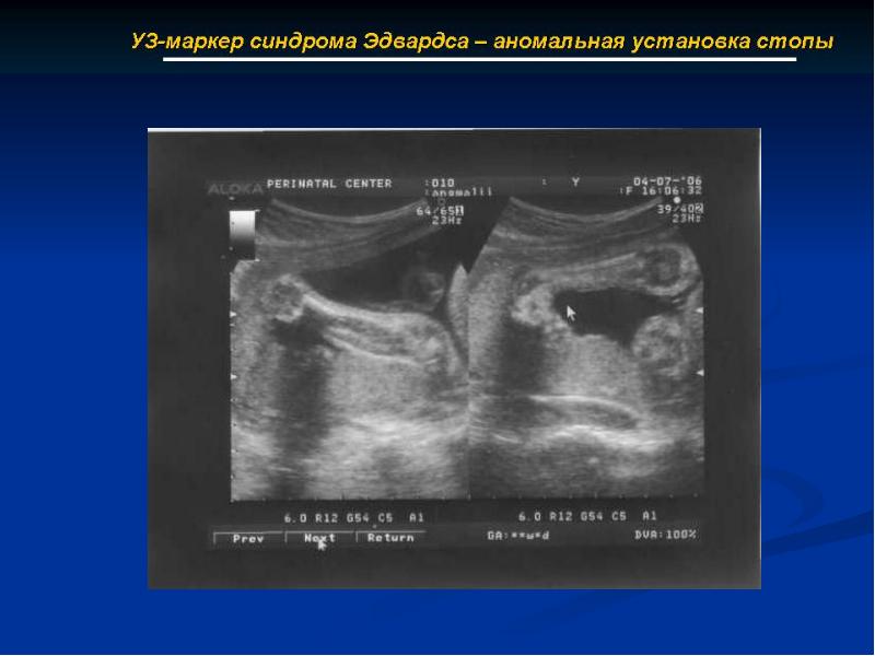 Синдром эдвардса фото узи