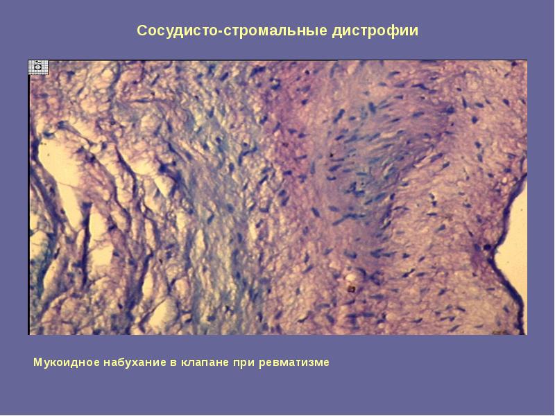 белково стромальная сосудистая дистрофия. характеристика стромально-сосудистых дистрофий. стромально-сосудистые белковые дистрофии. мезенхимальные углеводные дистрофии. стромально сосудистые дистрофии.
