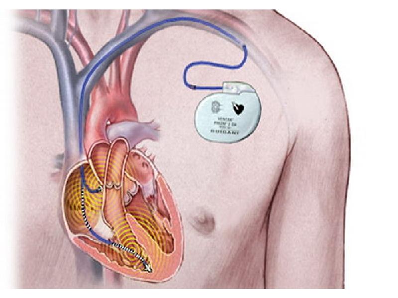 Как выглядит кардиостимулятор для сердца фото
