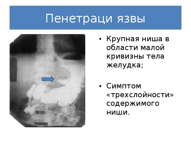 Язва малой кривизны желудка схема