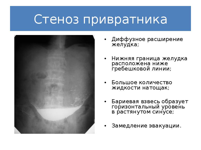 Сужение привратника