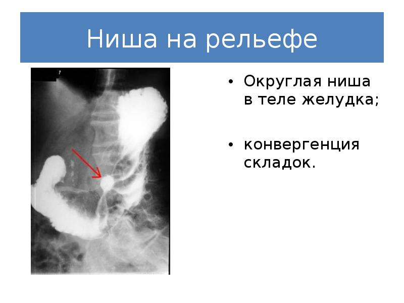 Реферат: Рентгенодиагностика язвенной болезни