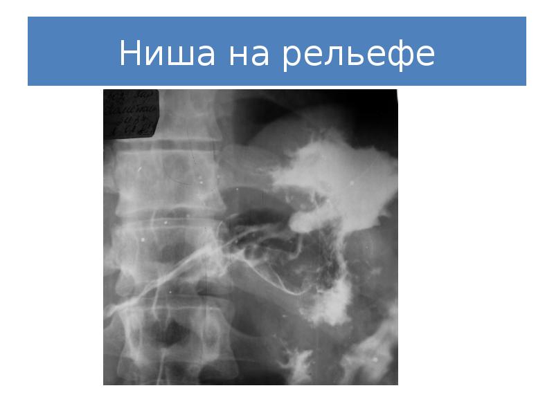 Реферат: Рентгенодиагностика язвенной болезни