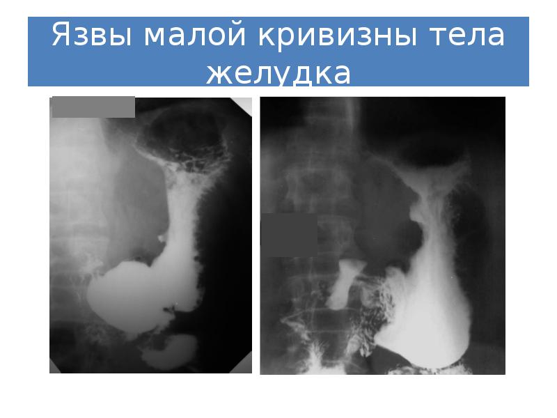 Реферат: Рентгенодиагностика язвенной болезни