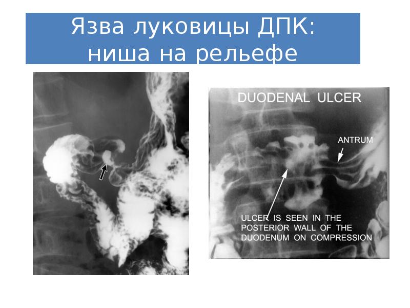 Реферат: Рентгенодиагностика язвенной болезни