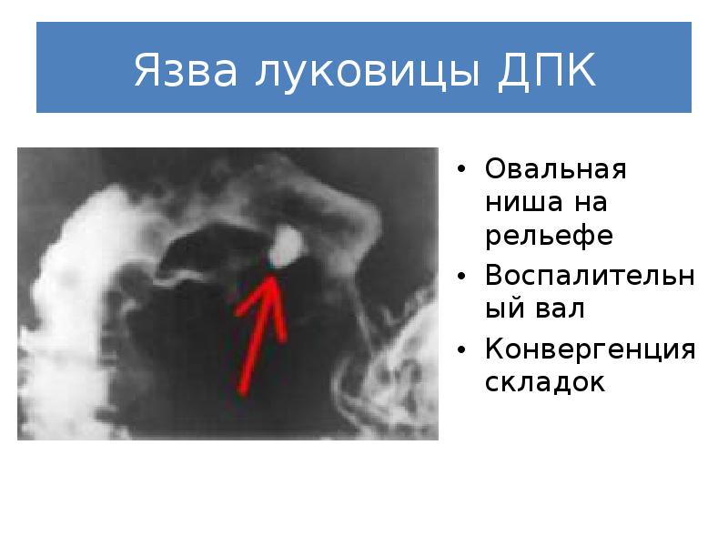 Реферат: Рентгенодиагностика язвенной болезни