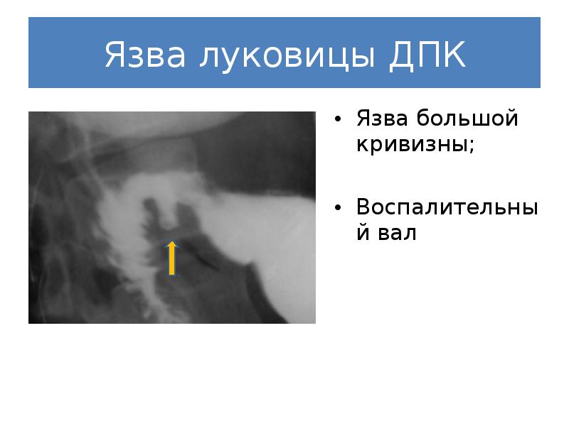 Реферат: Рентгенодиагностика язвенной болезни