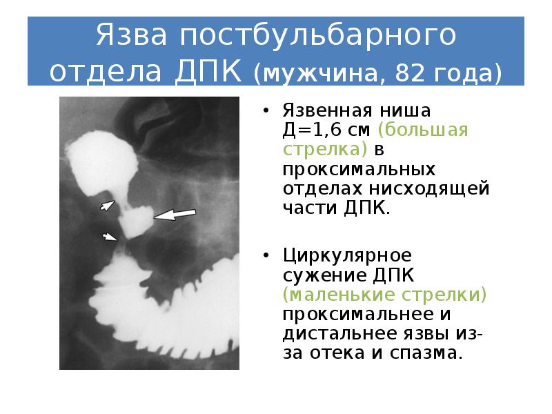 Реферат: Рентгенодиагностика язвенной болезни