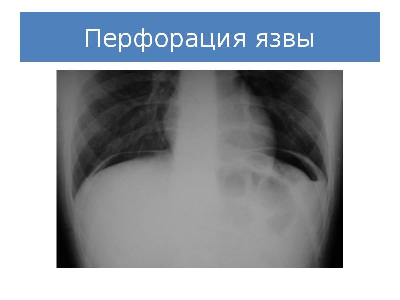 Реферат: Рентгенодиагностика язвенной болезни