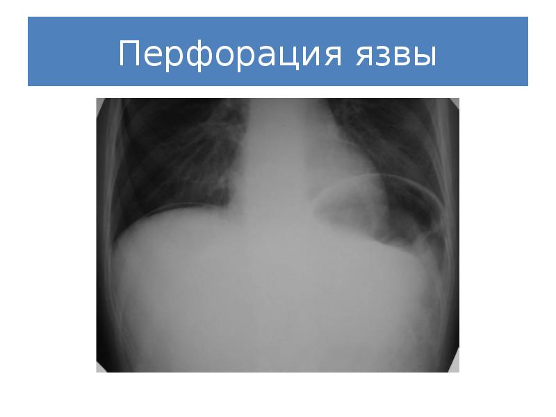 Диагностика перфоративной язвы. Диагностика перфоративной язвы