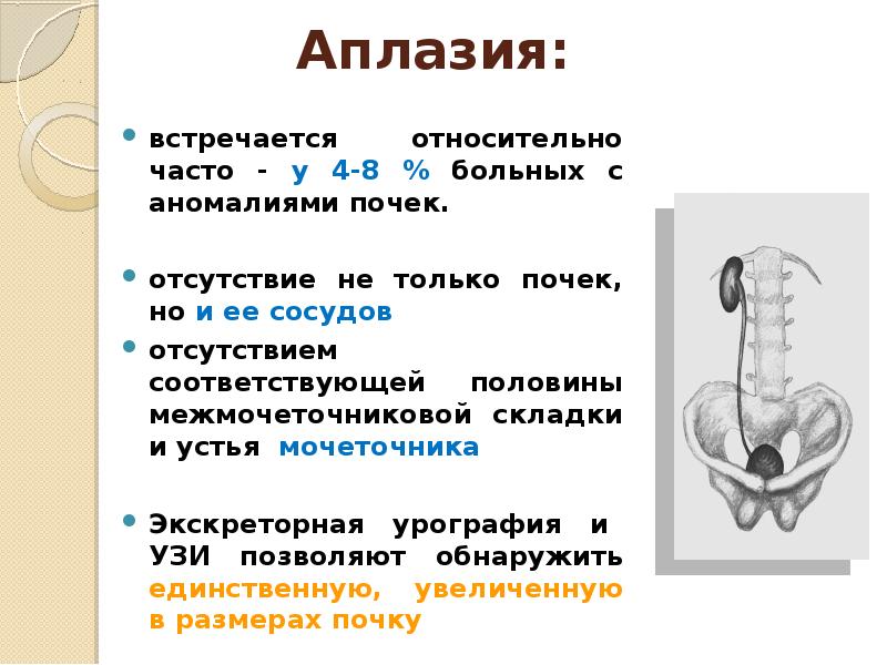 Аномалии мочеполовой системы презентация