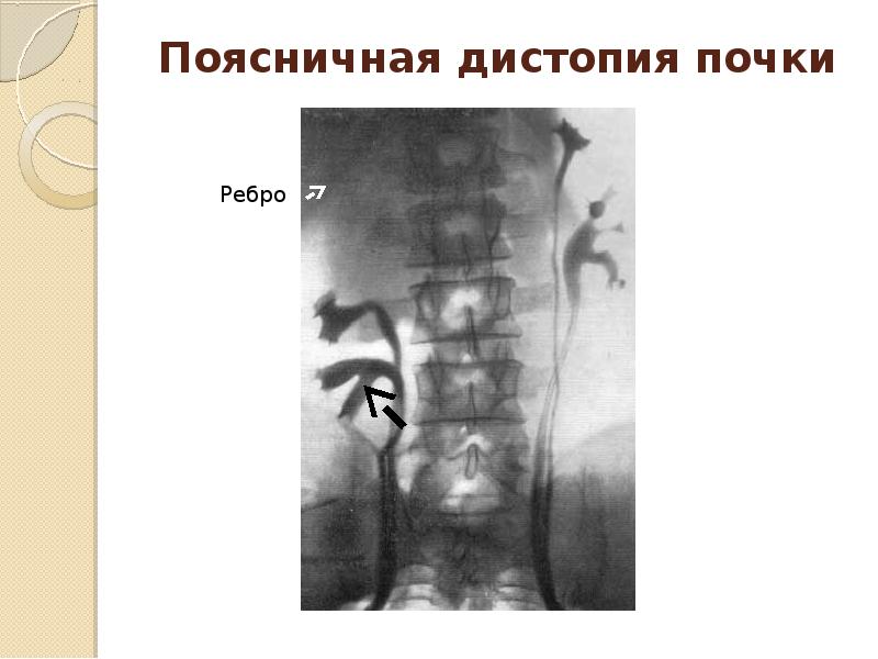 Врожденные пороки мочевыделительной системы презентация