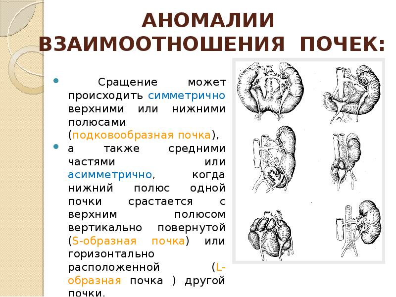 Аномалия развития почек презентация