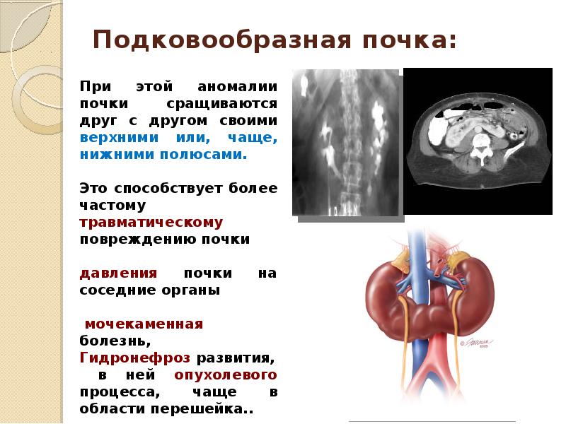 Аномалии мочеполовой системы презентация