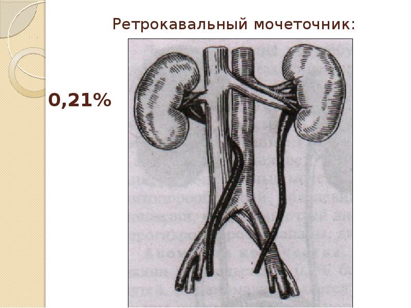 Аномалии мочеполовой системы презентация