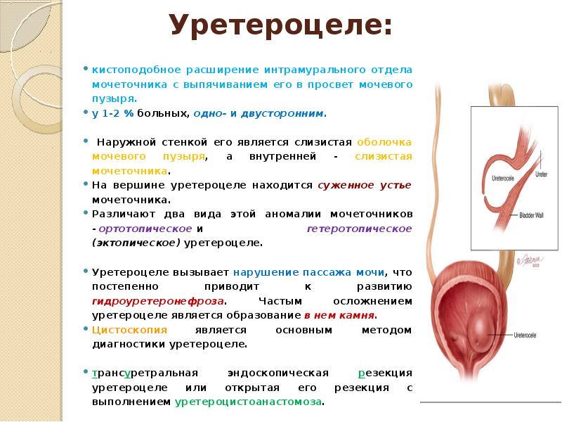 Мочевой пузырь норма у женщин. Уретероцеле мочевого пузыря на УЗИ протокол. Уретероцеле слева мочевого пузыря. Интрамуральные отделы мочеточника. Интрамуральный отдел мочеточника кт.