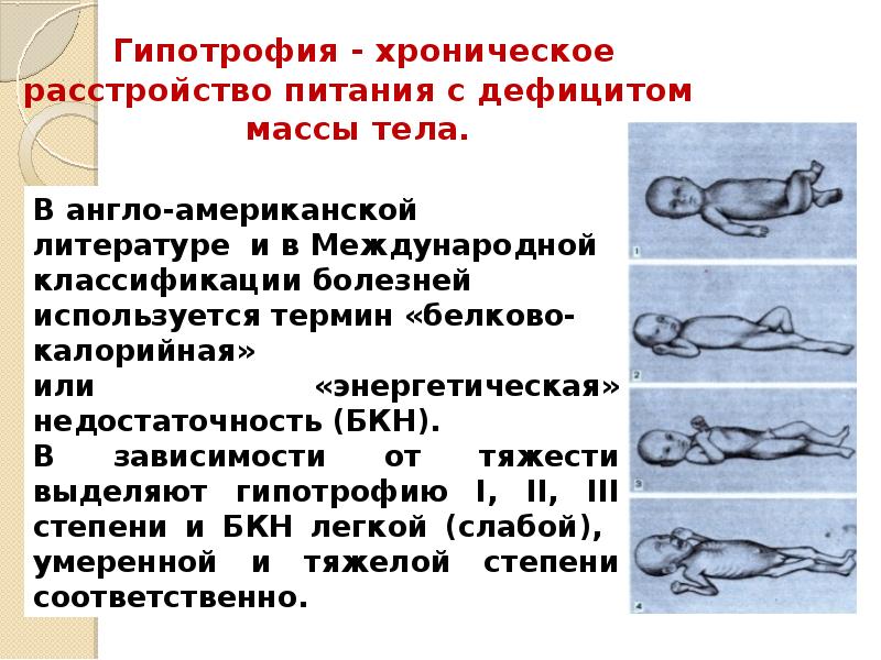 Недостаточность питания. Гипотрофия мкб. Гипотрофия код по мкб 10 у детей. Гипотрофия у детей по мкб. Код мкб 10 гипотрофия у детей.