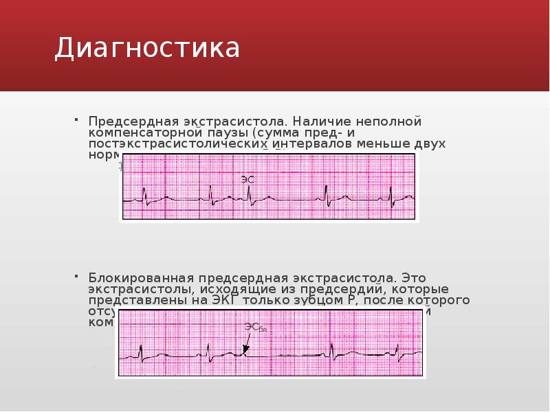 Предсердные экстрасистолы. Блокированная экстрасистола ЭКГ. Блокированная экстрасистола ЭКГ предсердная экстрасистолия. Парная блокированная предсердная экстрасистолия. Блокированная предсердная экстрасистолия на ЭКГ.