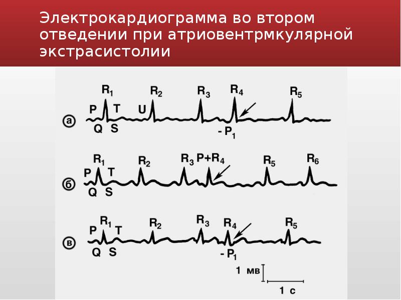 Экстрасистолы экг фото