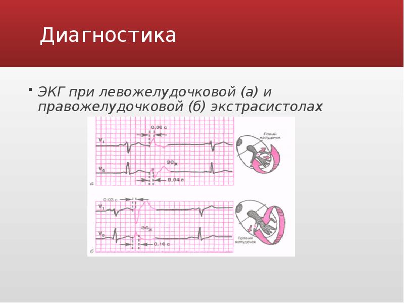 Экг диагностика. ЭКГ правожелудочковой экстрасистолии. Правожелудочковые и левожелудочковые экстрасистолы ЭКГ. Правожелудочковые экстрасистолы на ЭКГ. ЭКГ при правожелудочковой и левожелудочковой экстрасистолии.