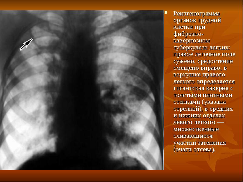 Рентген картина туберкулеза легких