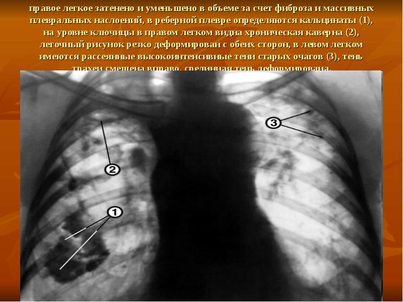 Инкрустация плевры рентгенологическая картина