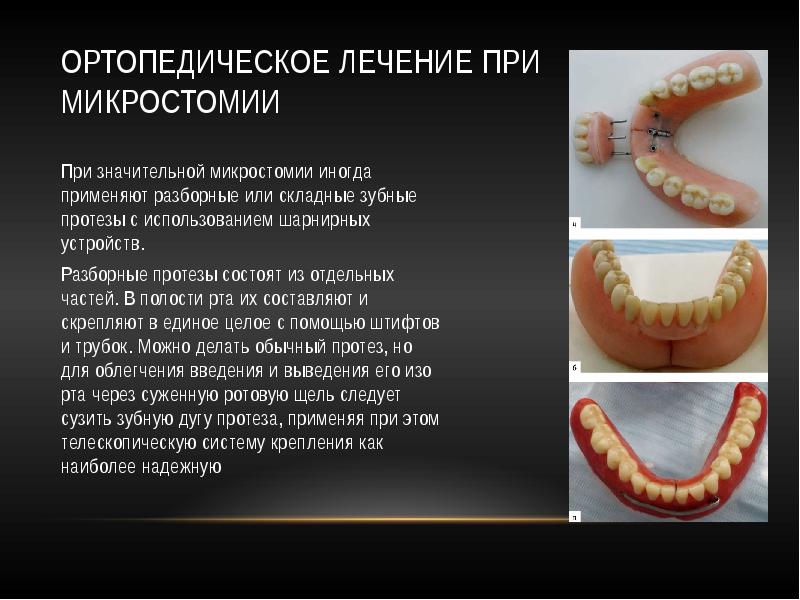 Ортопедическое лечение переломов нижней челюсти презентация